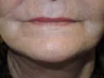 Laser Resurfacing