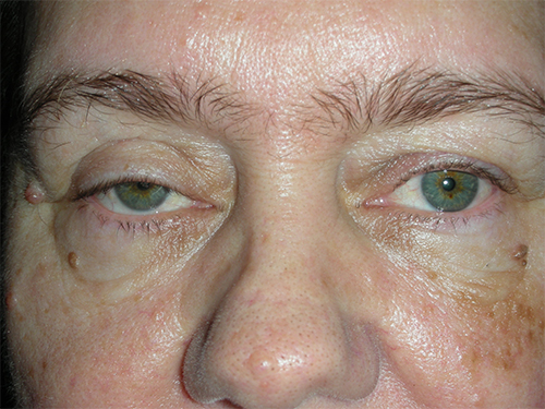 Functional Ptosis Repair