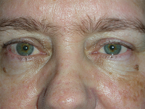 Functional Ptosis Repair