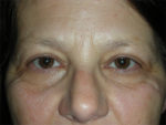 Functional Upper Eyelid Blepharoplasty