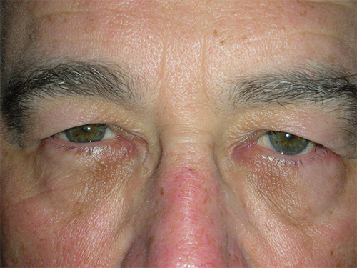 Functional Upper Eyelid Blepharoplasty