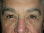 Functional Upper Eyelid Blepharoplasty