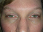 Functional Ptosis Repair