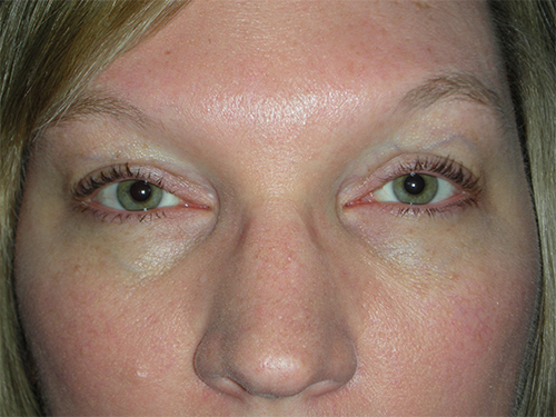 Functional Ptosis Repair