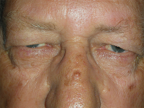 Functional Upper Eyelid Blepharoplasty