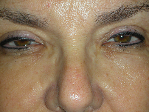 Functional Ptosis Repair