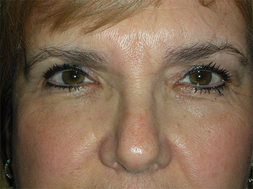 Functional Ptosis Repair