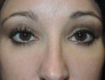 Lower Eyelid Blepharoplasty