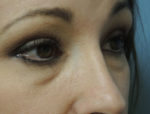 Lower Eyelid Blepharoplasty