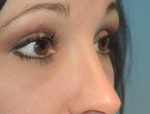 Lower Eyelid Blepharoplasty