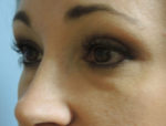 Lower Eyelid Blepharoplasty