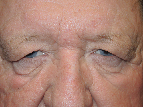 Functional Upper Eyelid Blepharoplasty