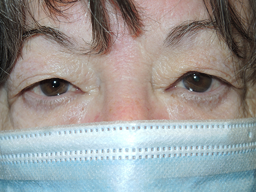 Functional Upper Eyelid Blepharoplasty