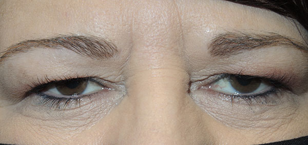 Cosmetic Browlift