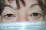 Functional Bilateral Upper Eyelid Blepharoplasty