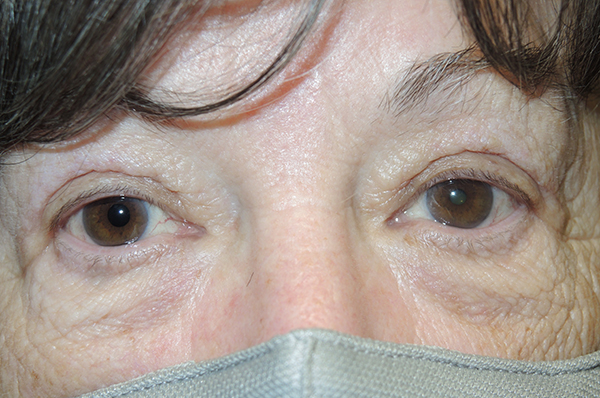 Functional Bilateral Upper Eyelid Blepharoplasty