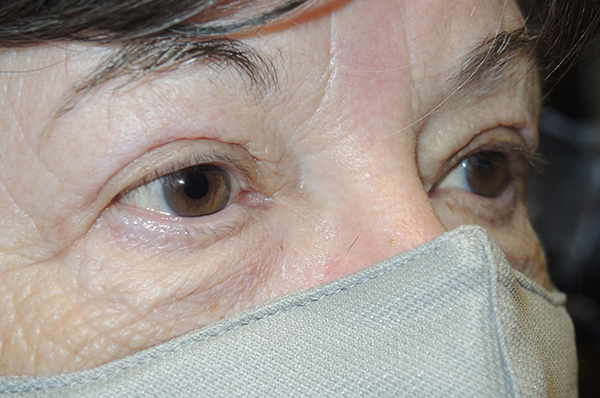 Functional Bilateral Upper Eyelid Blepharoplasty