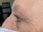 Functional Upper Eyelid Blepharoplasty