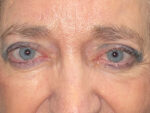 Functional Ptosis Repair