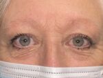 Functional Upper Eyelid Blepharoplasty