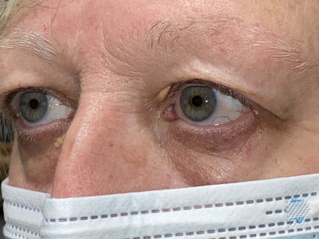 Functional Upper Eyelid Blepharoplasty