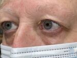 Functional Upper Eyelid Blepharoplasty