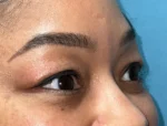 Lower Eyelid Blepharoplasty