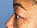 Lower Eyelid Blepharoplasty