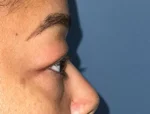 Lower Eyelid Blepharoplasty