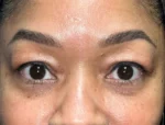 Lower Eyelid Blepharoplasty