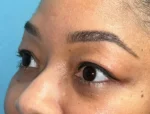 Lower Eyelid Blepharoplasty