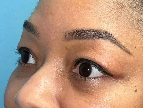 Lower Eyelid Blepharoplasty