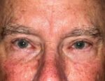 Lower Eyelid Blepharoplasty