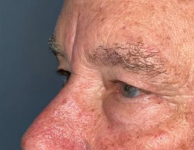 Lower Eyelid Blepharoplasty
