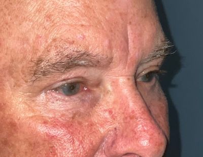Lower Eyelid Blepharoplasty