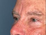 Lower Eyelid Blepharoplasty