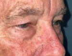 Lower Eyelid Blepharoplasty