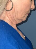 Facelift
