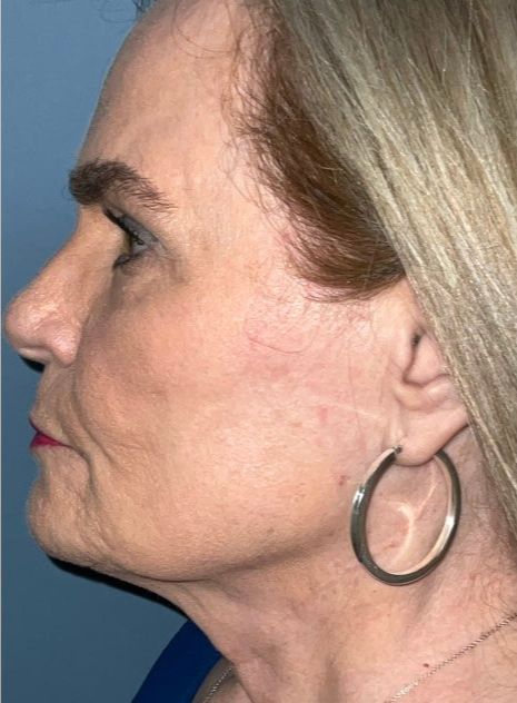 Facelift