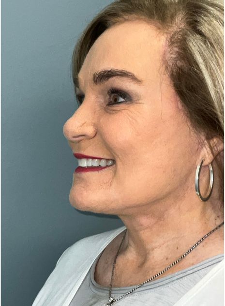 Facelift