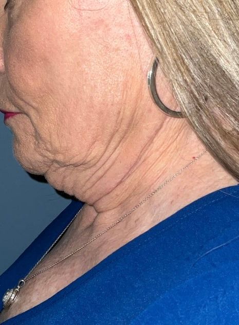 Facelift