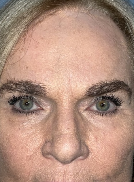Functional Browlift