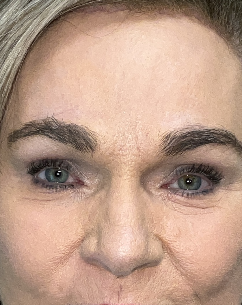 Functional Browlift