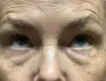 Lower Eyelid Blepharoplasty