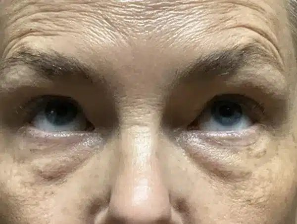 Lower Eyelid Blepharoplasty
