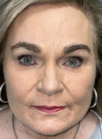 Cosmetic Browlift