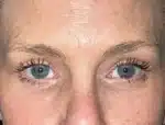 Lower Eyelid Blepharoplasty