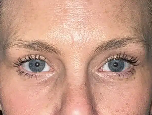 Lower Eyelid Blepharoplasty