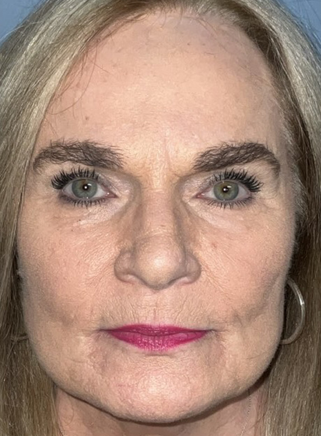 Cosmetic Browlift