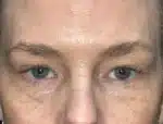 Lower Eyelid Blepharoplasty